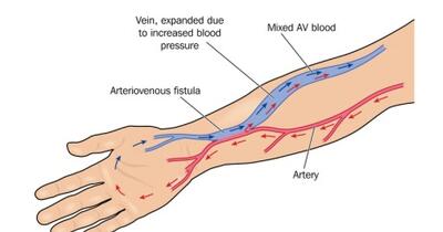 kidney characteristic edema kidney transplant qatar